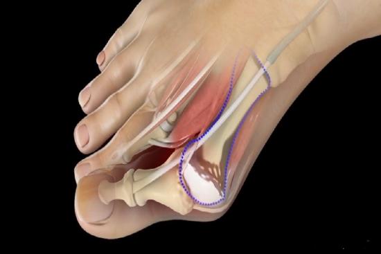 Quel âge pour opération hallux valgus ?