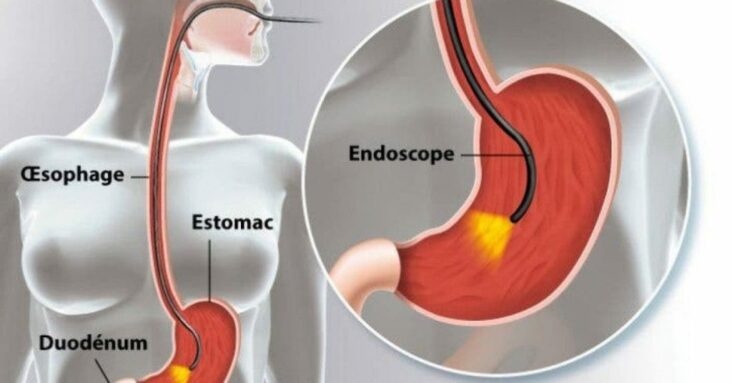 Quel sont les symptômes d'une bactérie dans l'estomac ?