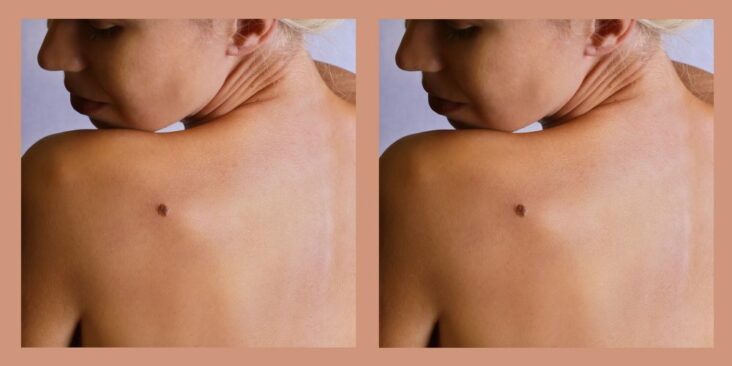 Quels sont les symptômes d'un cancer de la peau ?