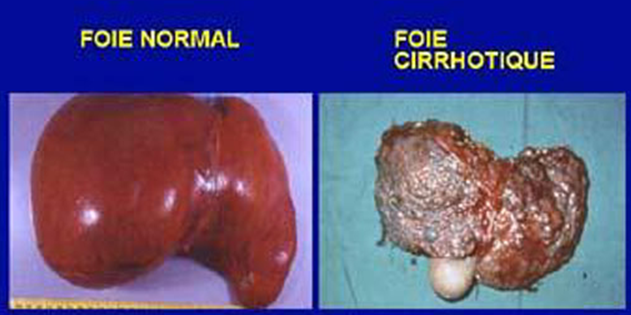 Qu'est-ce qui détruit le foie ?